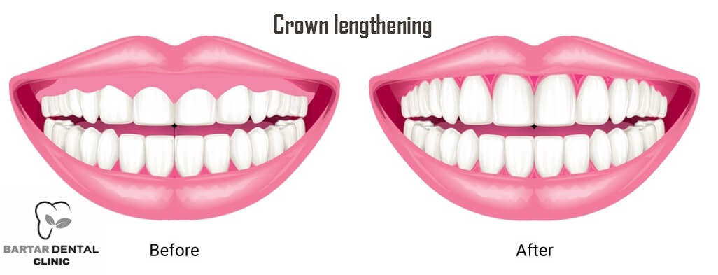 Crown lengthening