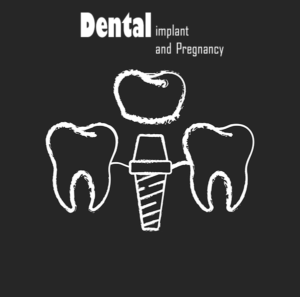 Dental implant3