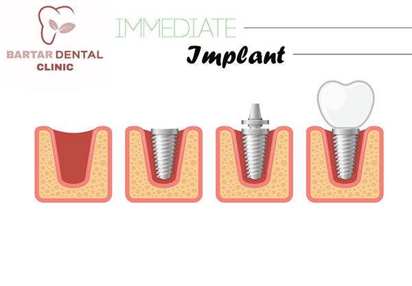 immediate implant
