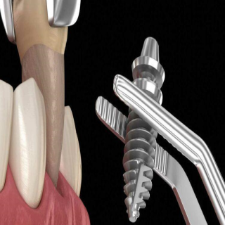 ایمپلنت فوری دندان چیست و چگونه انجام میشود؟