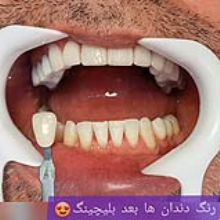 بلیچینگ دندان در کلینیک دندان پزشکی برتر