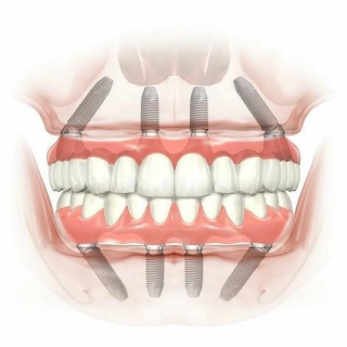 راهنمای ایمپلنت کامل کل دهان