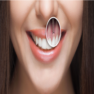 ایمپلنت دندان های قدامی ( جلو )