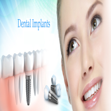 هزینه و قیمت ایمپلنت دندان 