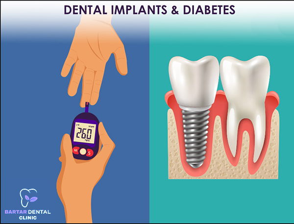 Dental implant and diabetes